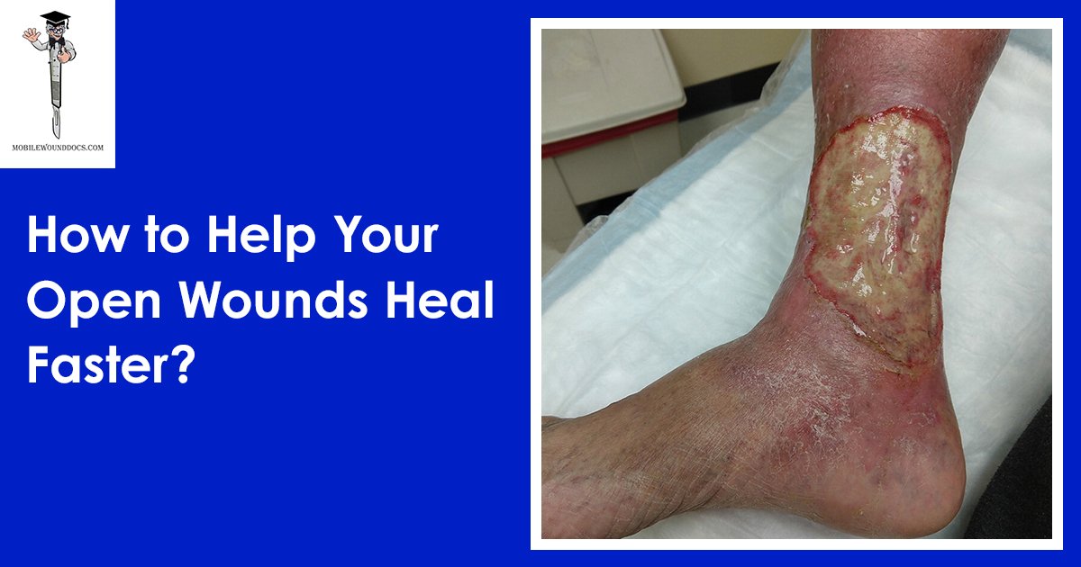 How to Help Your Open Wounds Heal Faster_